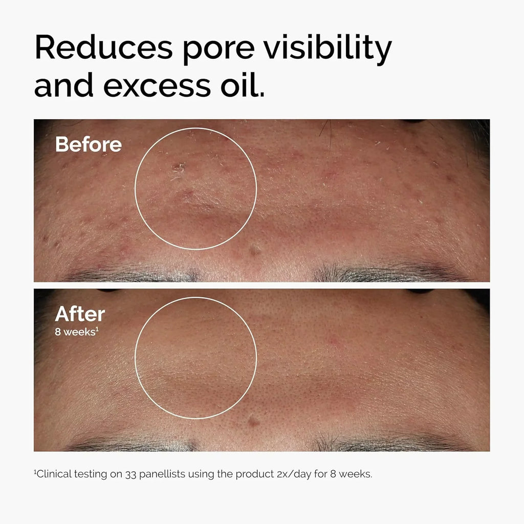 10% Niacinamide 1% Zinc Face Serum 30ml, Oil Control Pore Minimizer, Anti-Acne Dark Spot, Gentle Skin Care for All Skin Types