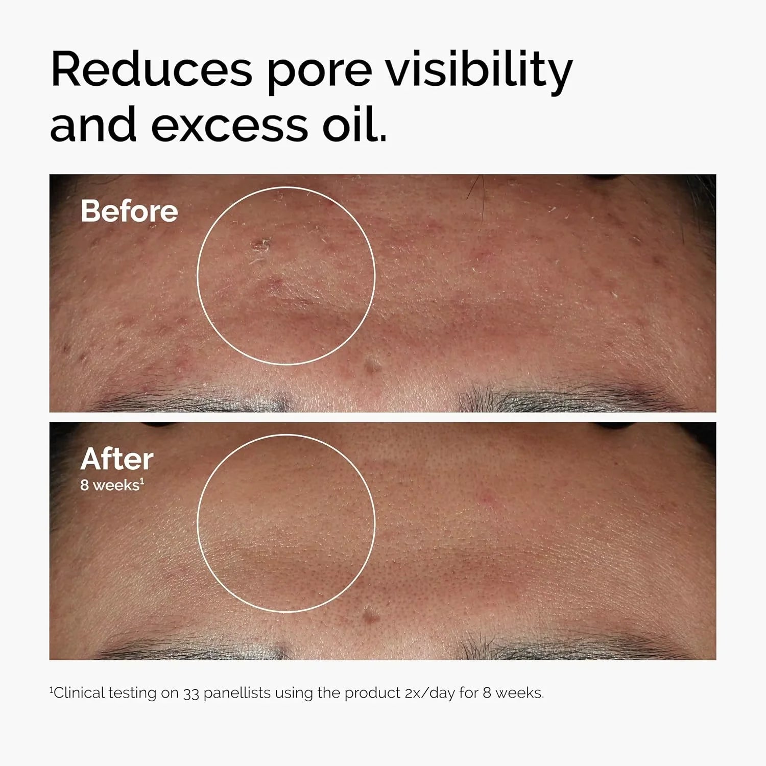 10% Niacinamide 1% Zinc Face Serum 30ml, Oil Control Pore Minimizer, Anti-Acne Dark Spot, Gentle Skin Care for All Skin Types